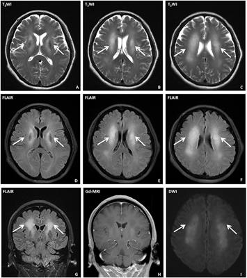 Anti-CV2 Autoimmune Encephalitis With Parkinson-Like Symptoms and Bilateral Leukoencephalopathy—A Case Report